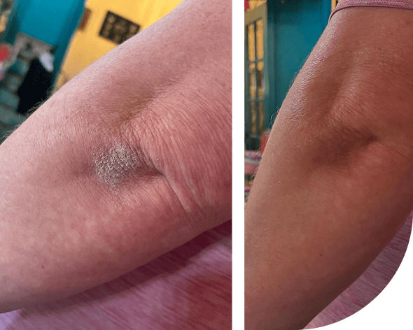 Elbow skin before and after treatment