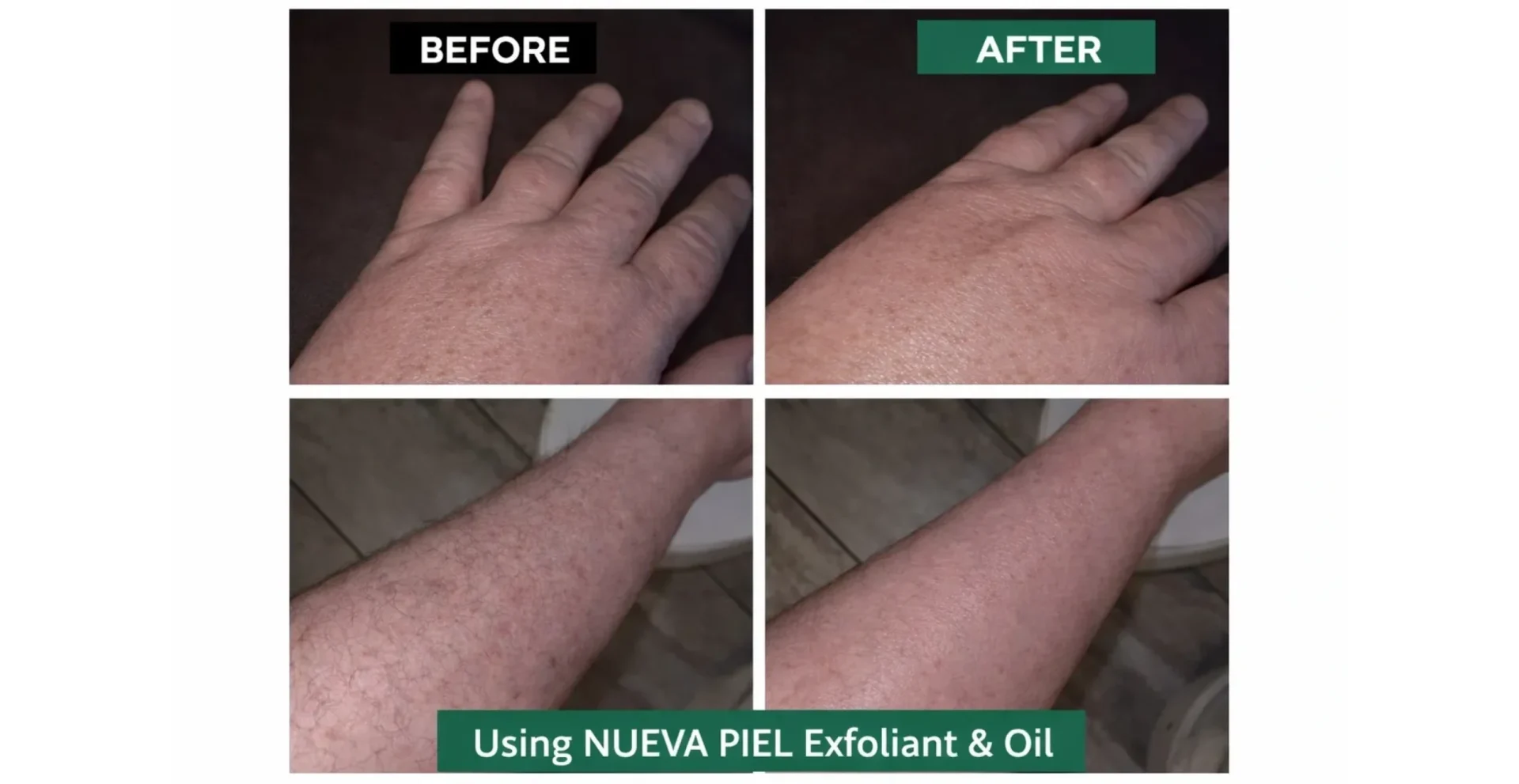 Skin improvement with exfoliant and oil